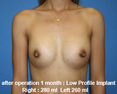 plastic-surgery-breast-augmentation